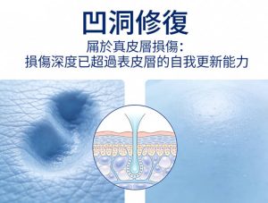 4大凹洞形成原因