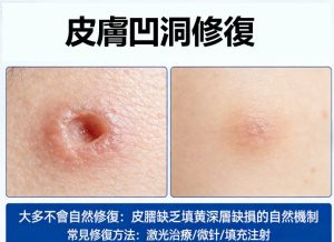 凹洞會自己好嗎？