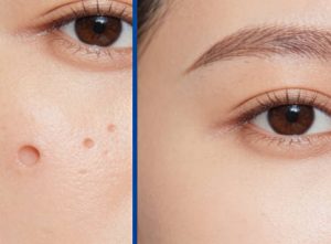 凹洞可以用醫美治療嗎