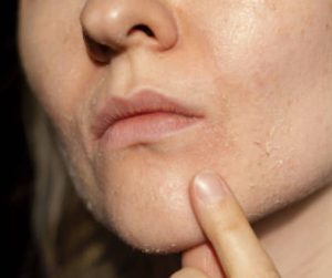 臉脫皮多久會好